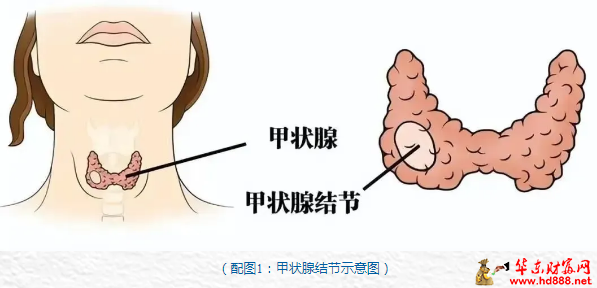 老年患者高難度甲狀腺癌手術(shù)成功！