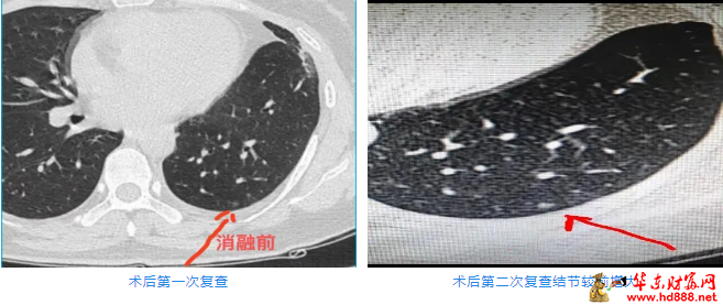 被“凍死”的結(jié)節(jié)：低溫冷凍，高效消瘤，肺結(jié)節(jié)患者健康的新選擇！